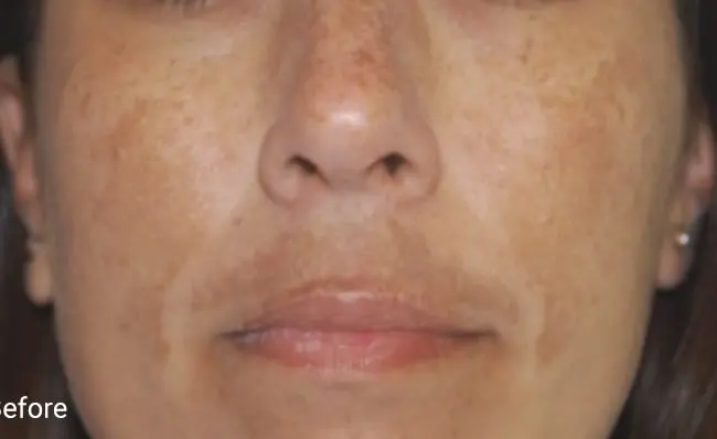 Clarity II Before and After - Case 2, Image 1 - Female, age  - Baltimore, MD - Skin Therapeutics Med Spa