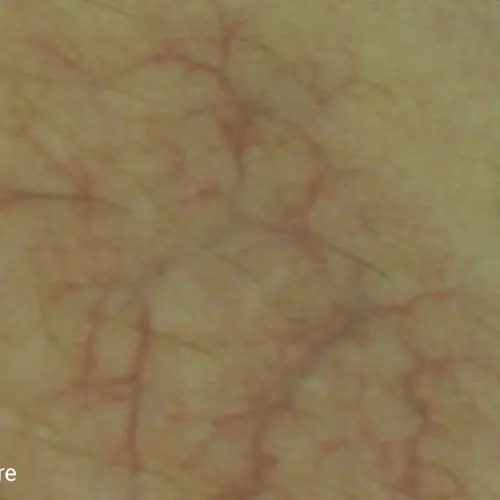 Clarity II Before and After - Case -1, Image 1 - N/A, age  - Baltimore, MD - Skin Therapeutics Med Spa