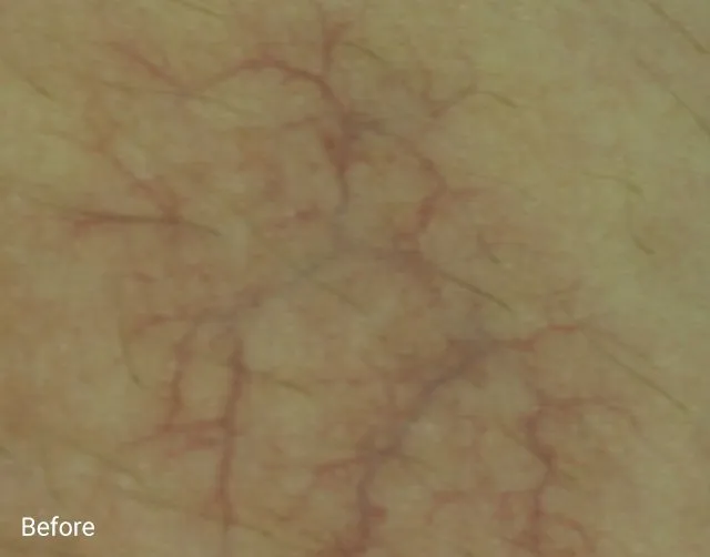 Clarity II Before and After - Case -1, Image 1 - N/A, age  - Baltimore, MD - Skin Therapeutics Med Spa