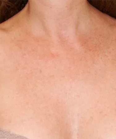 Laser360 Skin Rejuvenation Before and After - Case clearbrilliant4, Image 2 - Female, age  - Baltimore, MD - Skin Therapeutics Med Spa