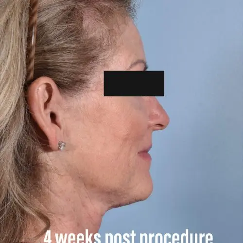 FaceTite Before and After - Case 2, Image 4 - Female, age  - Baltimore, MD - Skin Therapeutics Med Spa