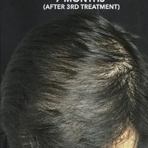 PRP Hair Restoration Before and After - Case -1, Image 2 - Male, age  - Baltimore, MD - Skin Therapeutics Med Spa