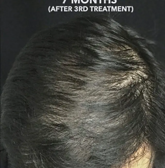 PRP Hair Restoration Before and After - Case -1, Image 2 - Male, age  - Baltimore, MD - Skin Therapeutics Med Spa