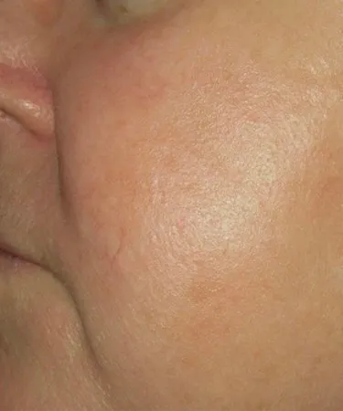 Laser360 Skin Rejuvenation Before and After - Case clearbrilliant3, Image 2 - Female, age  - Baltimore, MD - Skin Therapeutics Med Spa