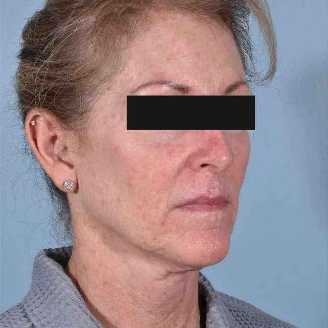 FaceTite Before and After - Case 2, Image 1 - Female, age  - Baltimore, MD - Skin Therapeutics Med Spa