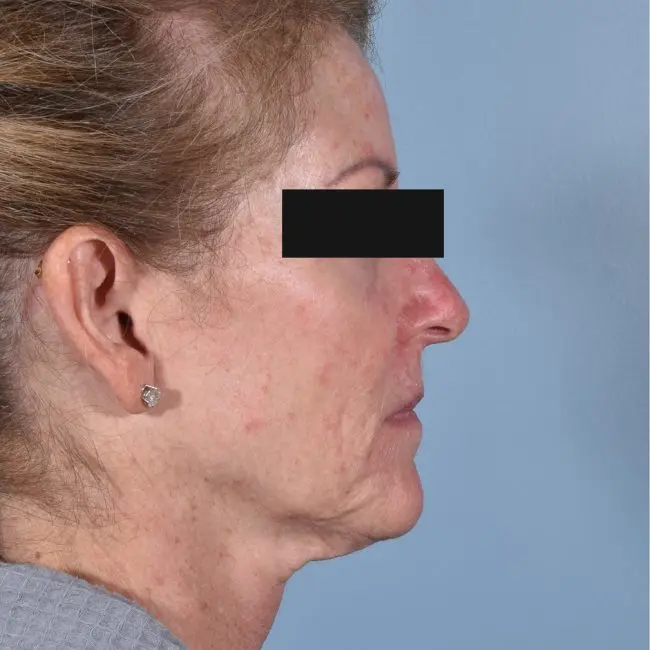 FaceTite Before and After - Case 2, Image 3 - Female, age  - Baltimore, MD - Skin Therapeutics Med Spa