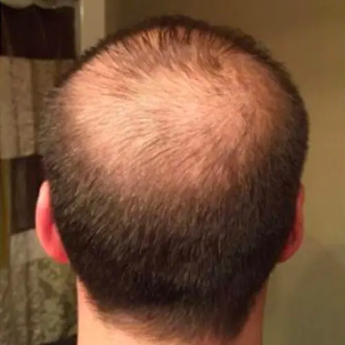 PRP Hair Restoration Before and After - Case 2, Image 1 - Male, age  - Baltimore, MD - Skin Therapeutics Med Spa