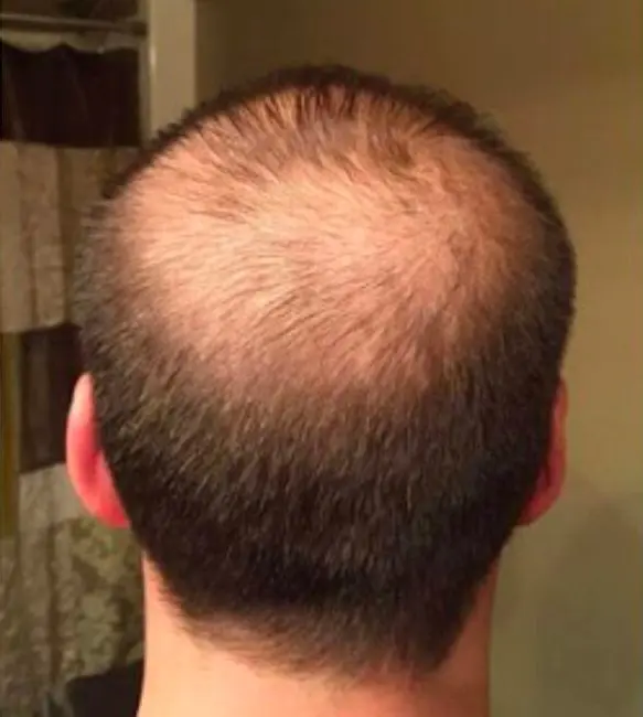 PRP Hair Restoration Before and After - Case 2, Image 1 - Male, age  - Baltimore, MD - Skin Therapeutics Med Spa