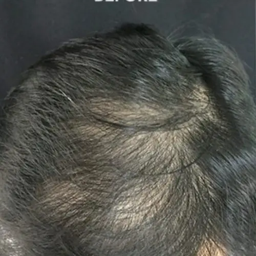 PRP Hair Restoration Before and After - Case -1, Image 1 - Male, age  - Baltimore, MD - Skin Therapeutics Med Spa