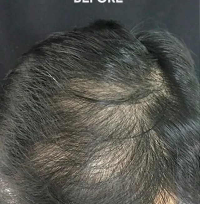 PRP Hair Restoration Before and After - Case -1, Image 1 - Male, age  - Baltimore, MD - Skin Therapeutics Med Spa