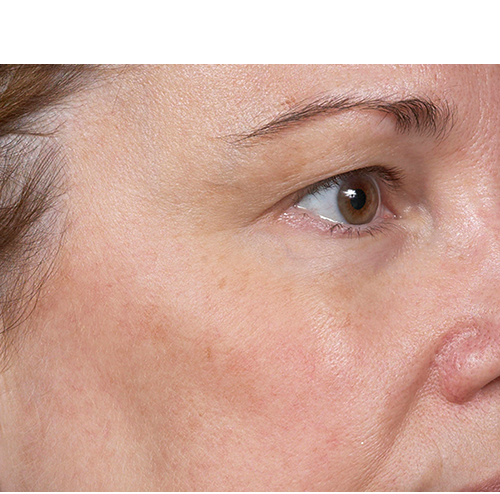 Clear + Brilliant Before and After - Case -1, Image 2 - Female, age  - Baltimore, MD - Skin Therapeutics Med Spa