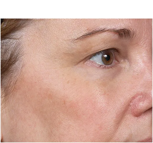 Clear + Brilliant Before and After - Case -1, Image 2 - Female, age  - Baltimore, MD - Skin Therapeutics Med Spa