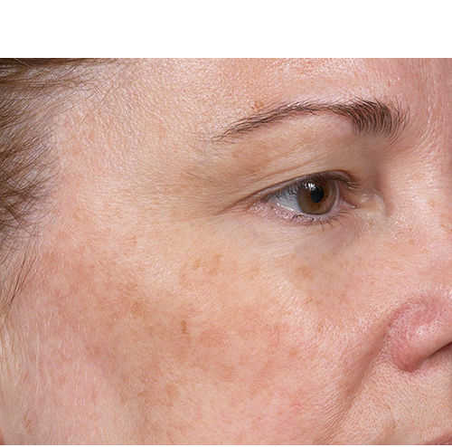 Clear + Brilliant Before and After - Case -1, Image 1 - Female, age  - Baltimore, MD - Skin Therapeutics Med Spa