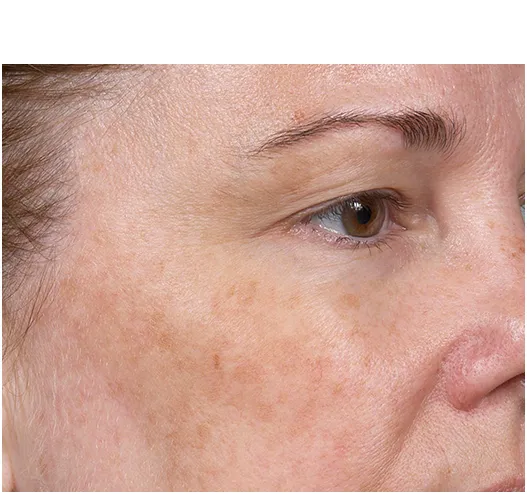 Clear + Brilliant Before and After - Case -1, Image 1 - Female, age  - Baltimore, MD - Skin Therapeutics Med Spa