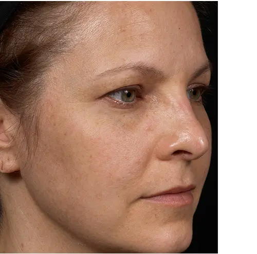 Clear + Brilliant Before and After - Case 2, Image 2 - Female, age  - Baltimore, MD - Skin Therapeutics Med Spa