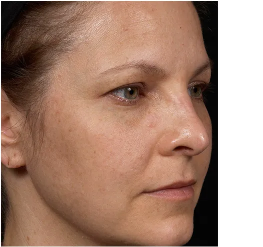 Clear + Brilliant Before and After - Case 2, Image 2 - Female, age  - Baltimore, MD - Skin Therapeutics Med Spa