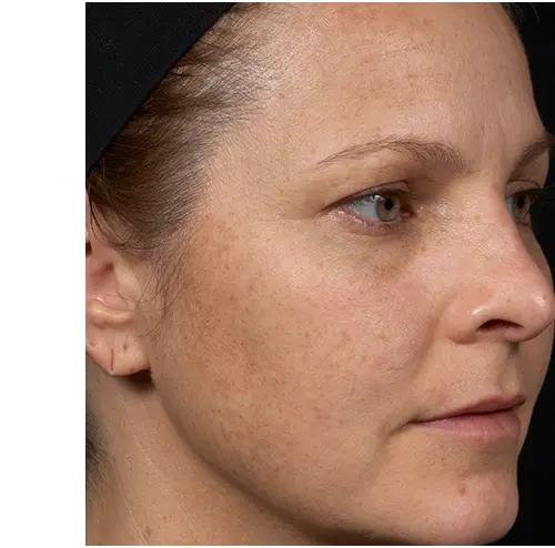 Clear + Brilliant Before and After - Case 2, Image 1 - Female, age  - Baltimore, MD - Skin Therapeutics Med Spa