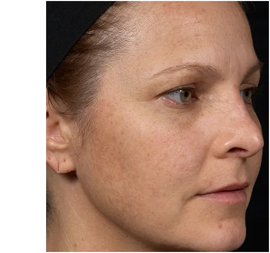 Clear + Brilliant Before & Afters | Skin Therapeutics Med Spa