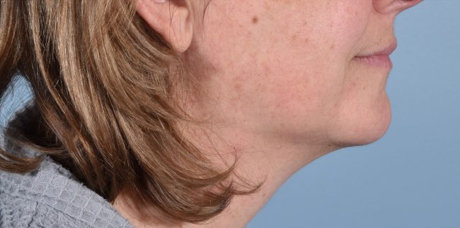 FaceTite Before and After - Case 3, Image 1 - Female, age 45 – 54 - Baltimore, MD - Skin Therapeutics Med Spa