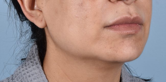 FaceTite Before and After - Case 5, Image 3 - Female, age 35 – 44 - Baltimore, MD - Skin Therapeutics Med Spa