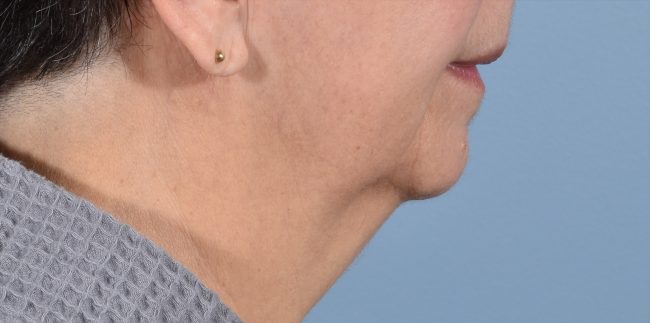 FaceTite Before and After - Case 4, Image 1 - Female, age 65+ - Baltimore, MD - Skin Therapeutics Med Spa