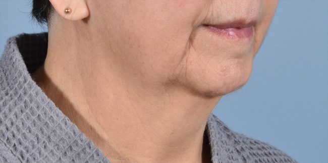 FaceTite Before and After - Case 4, Image 3 - Female, age 65+ - Baltimore, MD - Skin Therapeutics Med Spa