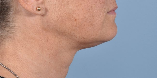 FaceTite Before and After - Case 6, Image 1 - Female, age 35 – 44 - Baltimore, MD - Skin Therapeutics Med Spa