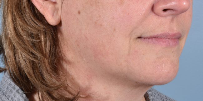 FaceTite Before and After - Case 3, Image 3 - Female, age 45 – 54 - Baltimore, MD - Skin Therapeutics Med Spa