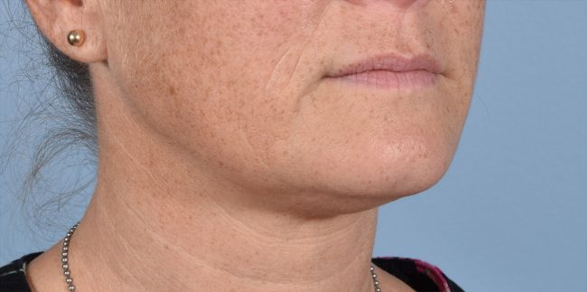 FaceTite Before and After - Case 6, Image 3 - Female, age 35 – 44 - Baltimore, MD - Skin Therapeutics Med Spa