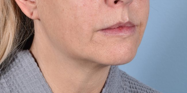 FaceTite Before and After - Case 7, Image 3 - Female, age 35 – 44 - Baltimore, MD - Skin Therapeutics Med Spa