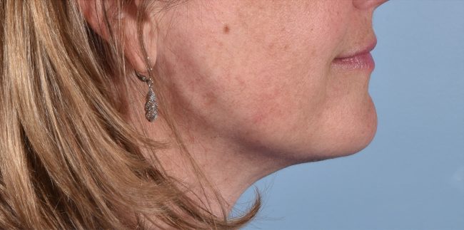 FaceTite Before and After - Case 3, Image 2 - Female, age 45 – 54 - Baltimore, MD - Skin Therapeutics Med Spa