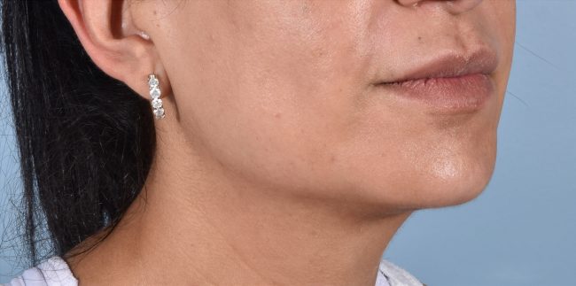 FaceTite Before and After - Case 5, Image 4 - Female, age 35 – 44 - Baltimore, MD - Skin Therapeutics Med Spa