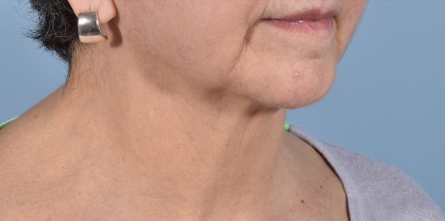 FaceTite Before and After - Case 4, Image 4 - Female, age 65+ - Baltimore, MD - Skin Therapeutics Med Spa