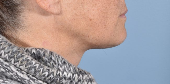 FaceTite Before and After - Case 6, Image 2 - Female, age 35 – 44 - Baltimore, MD - Skin Therapeutics Med Spa