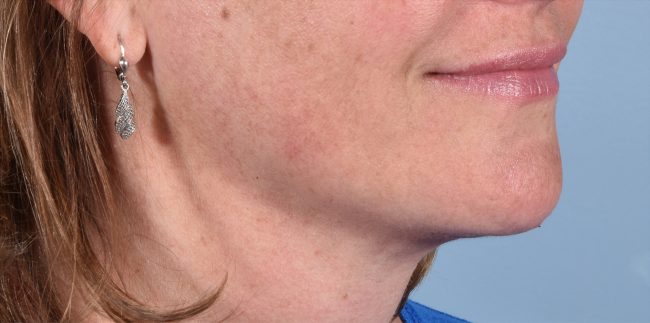 FaceTite Before and After - Case 3, Image 4 - Female, age 45 – 54 - Baltimore, MD - Skin Therapeutics Med Spa