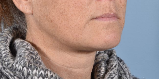 FaceTite Before and After - Case 6, Image 4 - Female, age 35 – 44 - Baltimore, MD - Skin Therapeutics Med Spa