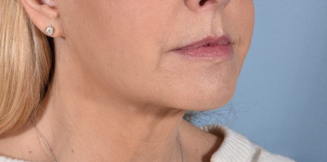 FaceTite Before and After - Case 7, Image 4 - Female, age 35 – 44 - Baltimore, MD - Skin Therapeutics Med Spa