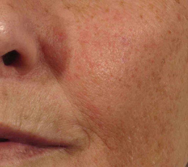 Glo2Facial Before and After - Case -1, Image 4 - N/A, age  - Baltimore, MD - Skin Therapeutics Med Spa