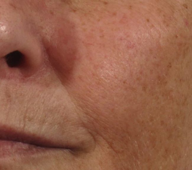 Glo2Facial Before and After - Case -1, Image 3 - N/A, age  - Baltimore, MD - Skin Therapeutics Med Spa