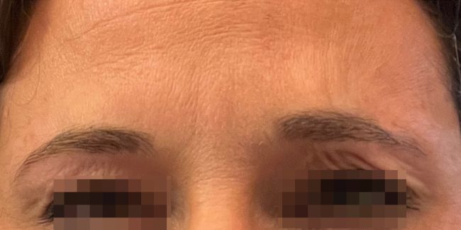 Dysport Before and After - Case 5, Image 2 - Female, age 25 – 34 - Baltimore, MD - Skin Therapeutics Med Spa