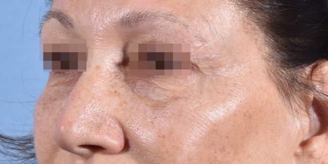 Fillers Before and After - Case 30, Image 4 - Female, age 35 – 44 - Baltimore, MD - Skin Therapeutics Med Spa