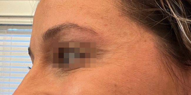 Dysport Before and After - Case 5, Image 4 - Female, age 25 – 34 - Baltimore, MD - Skin Therapeutics Med Spa