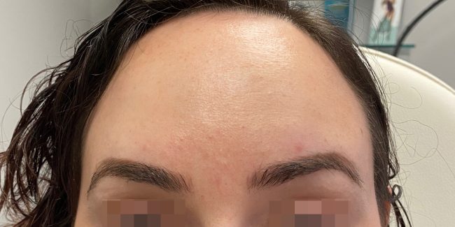 Dysport Before and After - Case 6, Image 4 - Female, age 25 – 34 - Baltimore, MD - Skin Therapeutics Med Spa