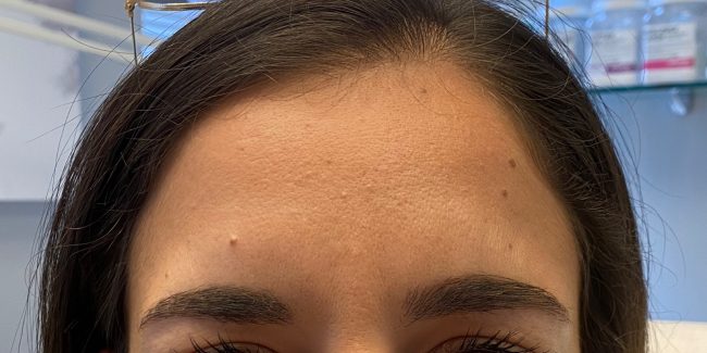 Dysport Before and After - Case 3, Image 4 - Female, age 25 – 34 - Baltimore, MD - Skin Therapeutics Med Spa