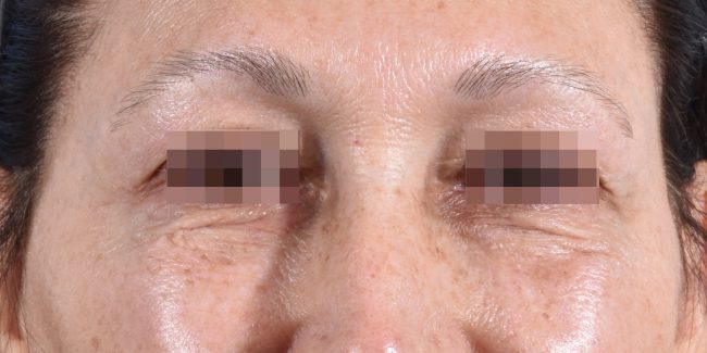 Fillers Before and After - Case 30, Image 6 - Female, age 35 – 44 - Baltimore, MD - Skin Therapeutics Med Spa