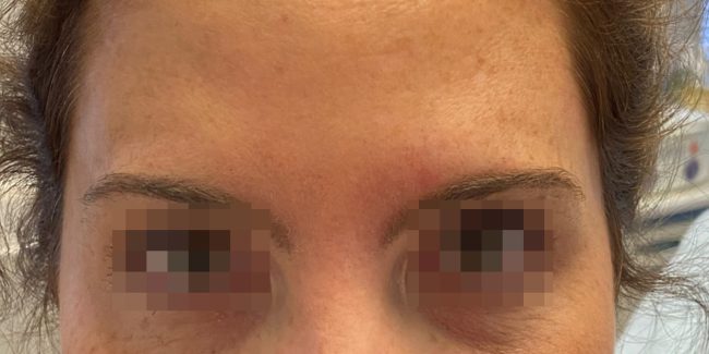 Dysport Before and After - Case 7, Image 2 - Female, age 25 – 34 - Baltimore, MD - Skin Therapeutics Med Spa