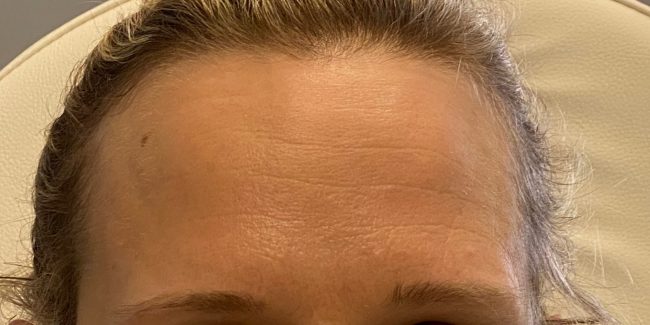 Botox Before and After - Case 8, Image 2 - Female, age 35 – 44 - Baltimore, MD - Skin Therapeutics Med Spa