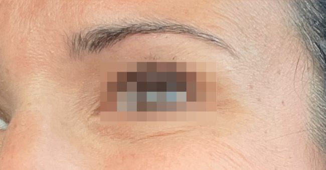 Botox Before and After - Case 7, Image 2 - Female, age 35 – 44 - Baltimore, MD - Skin Therapeutics Med Spa