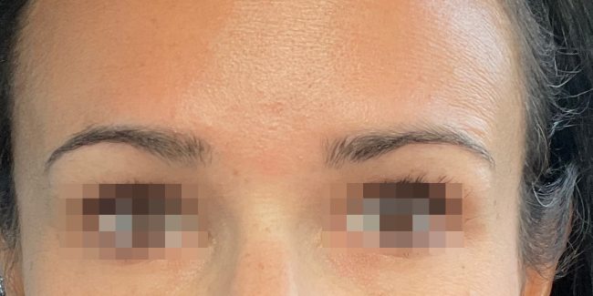 Botox Before and After - Case 7, Image 4 - Female, age 35 – 44 - Baltimore, MD - Skin Therapeutics Med Spa