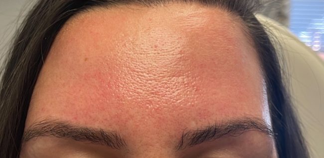 Dysport Before and After - Case -1, Image 2 - Female, age 35 – 44 - Baltimore, MD - Skin Therapeutics Med Spa